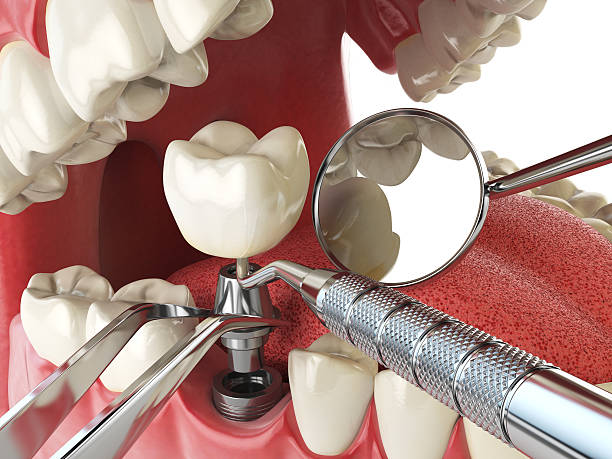 Best Emergency Treatment for Dental Infections or Abscesses in Wellington, FL